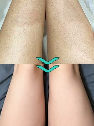 다리 닭살 모공각화증 원인? 홈케어 3가지면 극복 가능