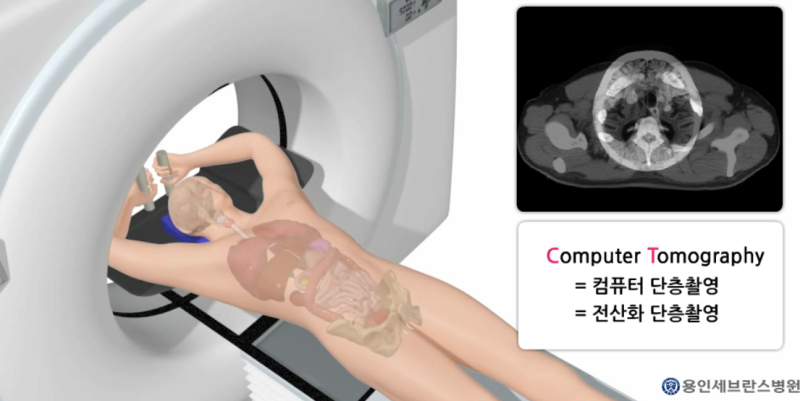 복부 CT 흉부 CT 차이점과 비용,조영제