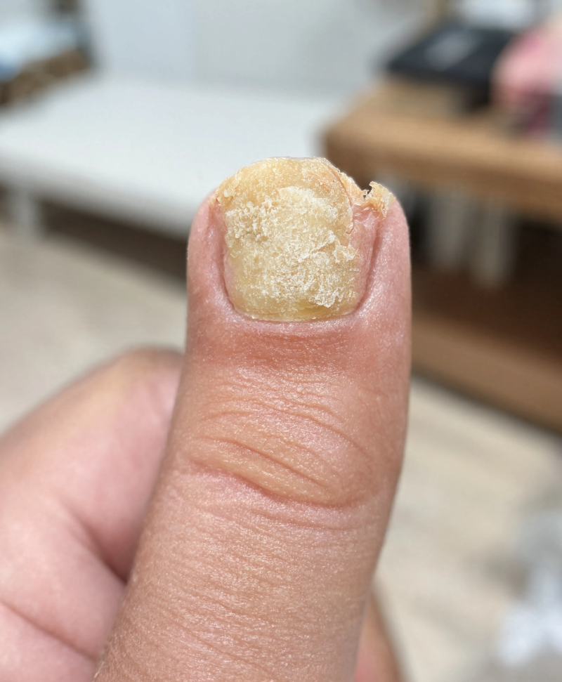손톱무좀 네일 받아도 될까, 주의사항 확인