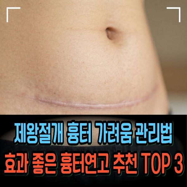 제왕절개 흉터 가려움 관리법과 효과 좋은 흉터연고 추천 TOP 3