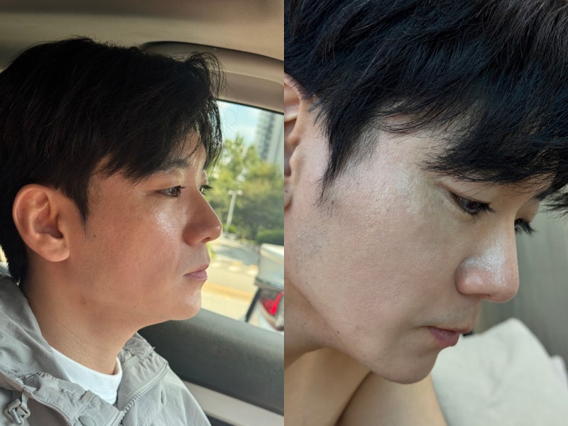 인천성형외과 고우리 스킨부스터 2주차 후기, 피부결과 리프팅 변화
