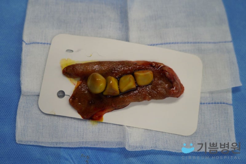 담낭 결석이 있으면 무조건 제거수술을 받아야 하나요? 쓸개 없이 살아도 괜찮나요?