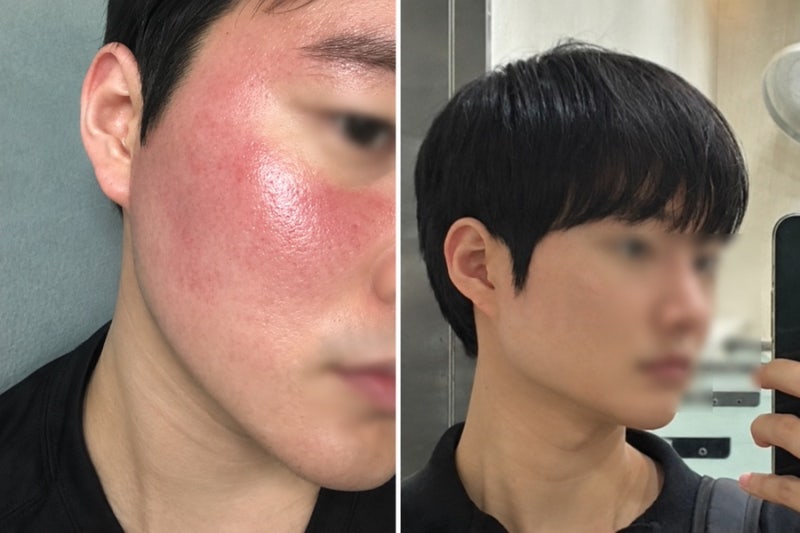[주사피부염 일대기] 수란트라, 미노씬 등 직접 경험한 - 8년 간의 주사피부염과 사투, 완치 ....