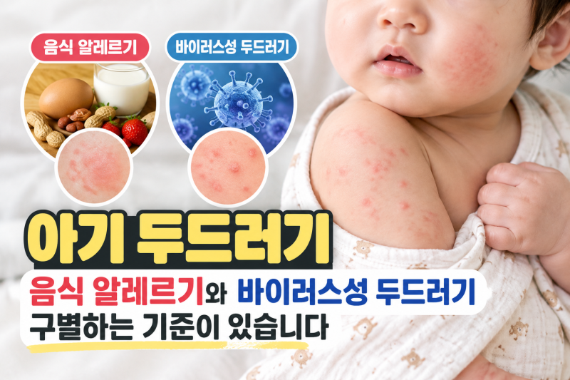 아기 두드러기 — 음식 알레르기와 바이러스성 두드러기 구별하는 기준이 있습니다