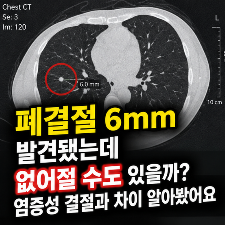 폐결절 6mm 발견됐는데 없어질 수도 있을까? 염증성 결절과 차이 알아봤어요