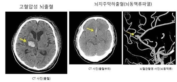 [건강정보] 뇌출혈 후 MRI검사 결과 정상인데 두통은 계속되는 진짜 이유 (뇌출혈 후유증과 중....
