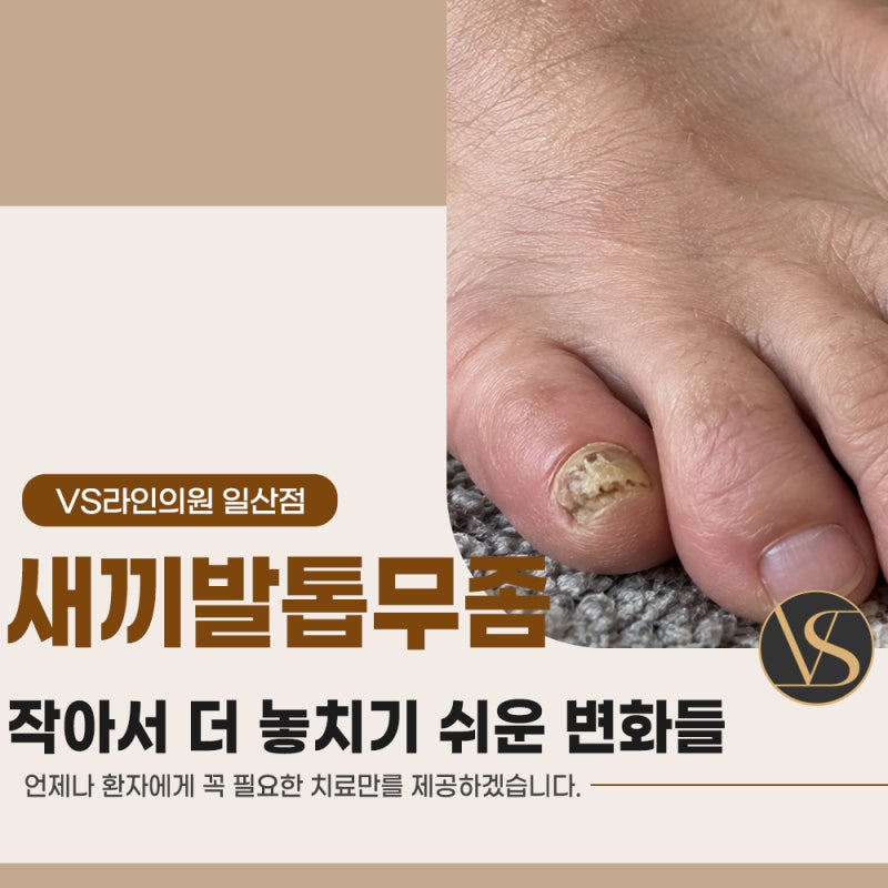 고양시 새끼발톱무좀, 작아서 더 놓치기 쉬운 변화들