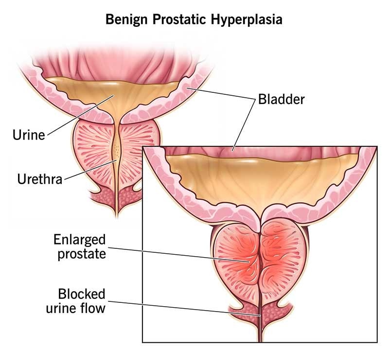 전립선 비대증 benign prostatic hyperplasia: “밤마다 세 번씩 일어나는 것이 나이 탓이라고요?” ....