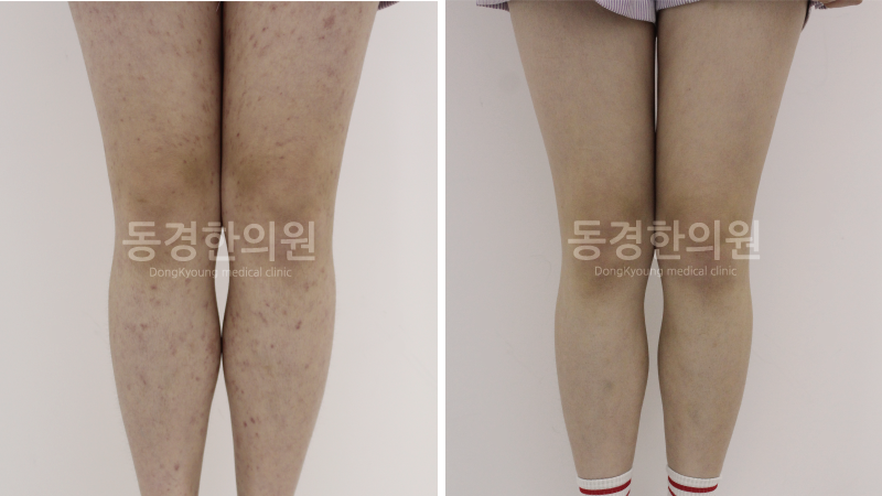 알레르기 자반증 증상, 한의원의 치료법