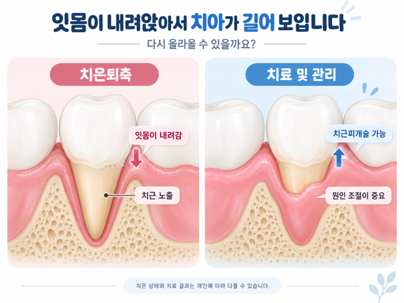 잇몸이 내려앉고 치아가 길어 보인다면, 다시 회복할 수 있을까요?