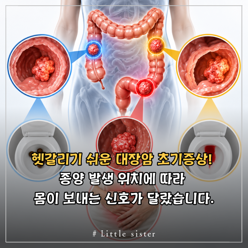 헷갈리기 쉬운 대장암 초기증상! 종양 발생 위치에 따라 몸이 보내는 신호가 달랐습니다.