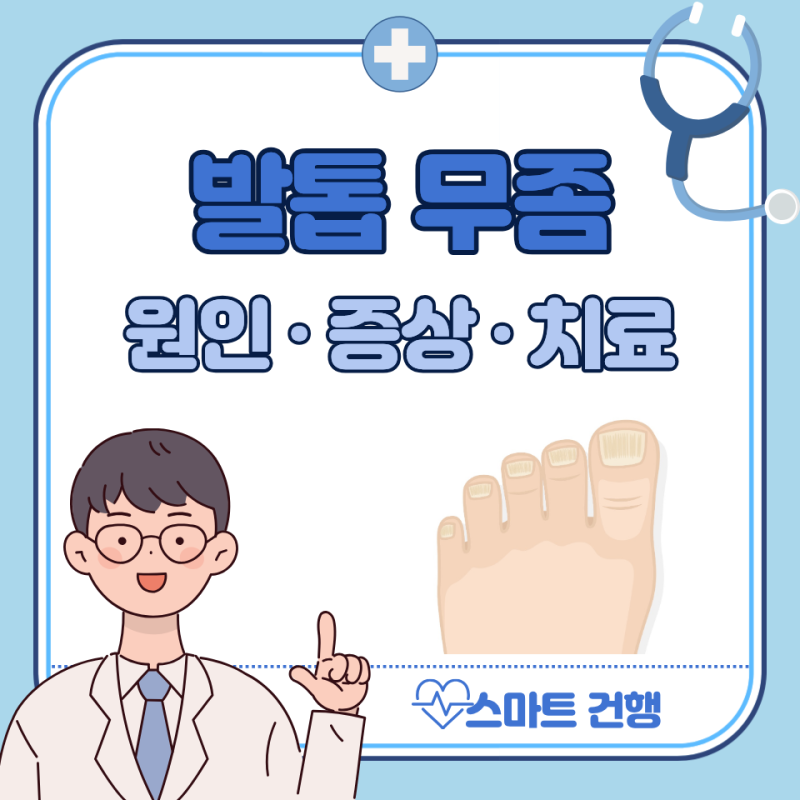 발톱무좀 치료방법 : 연고, 레이저, 바르는 발톱무좀약