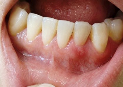 잇몸염증약 먹는 것 vs 바르는 것 + 가글 뭐가 다를까? 종류별 정리