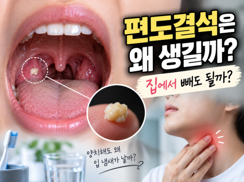 편도결석은 왜 생길까? 집에서 빼도 될까?