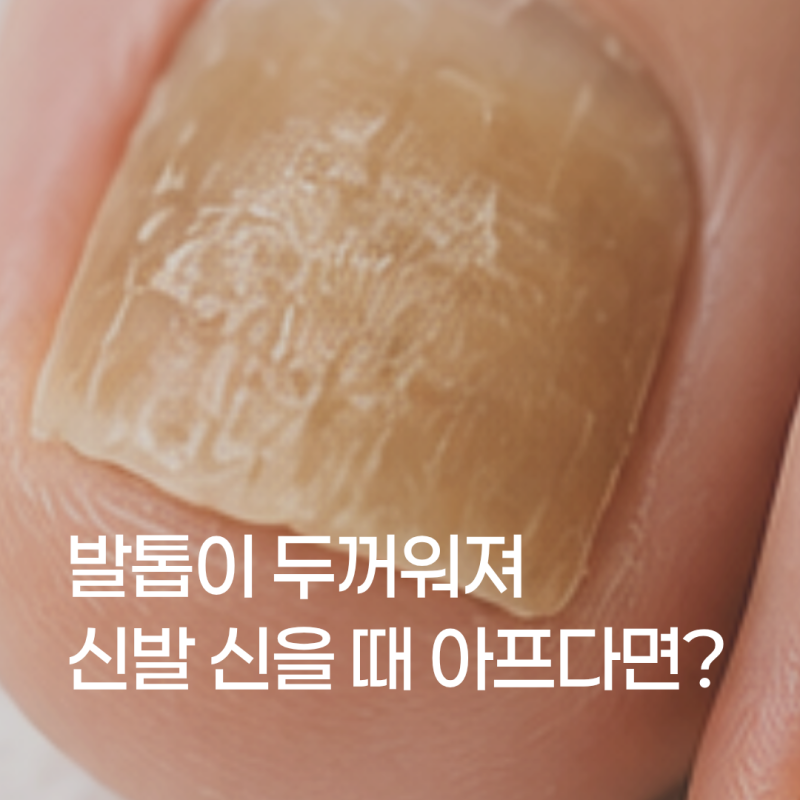 성동구 발톱무좀, 발톱이 두꺼워져 신발 신을 때 아프다면?(365다움의원)