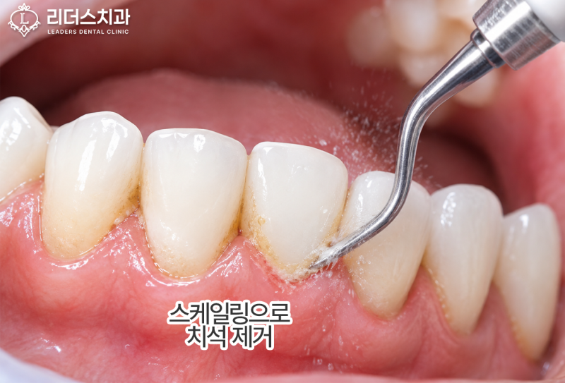 월배역치과 스케일링 후 치아 시림, 이유가 뭘까요?