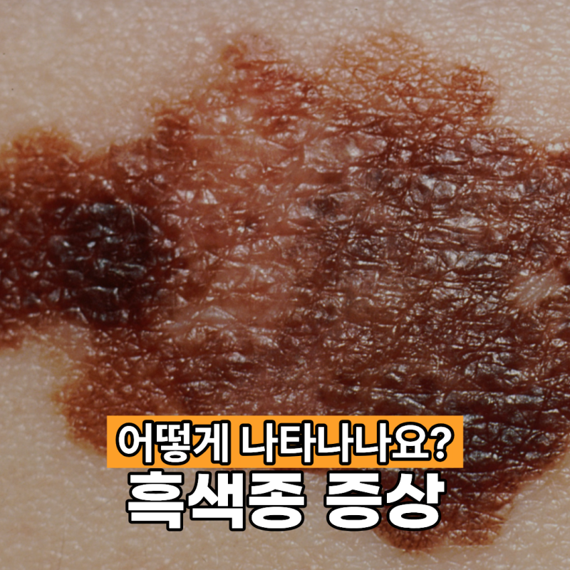 흑색종 증상 어떻게 나타나나요?