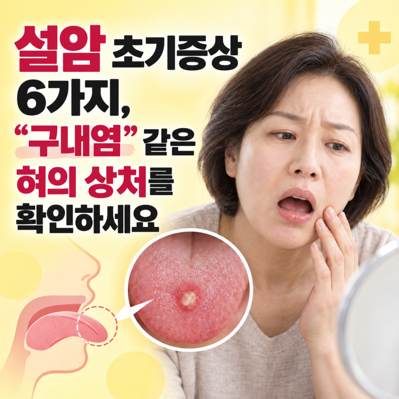 설암초기증상 6가지, “구내염” 같은 혀의 상처를 확인하세요