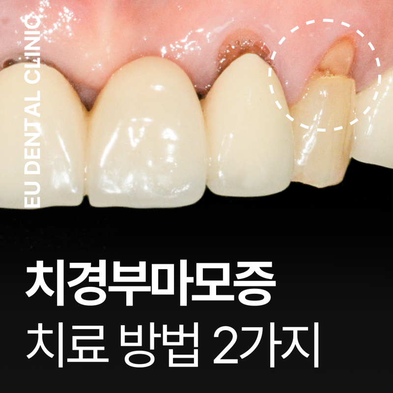 치아 잇몸패임 치경부마모증 레진 크라운 2가지로 해결 가능할까