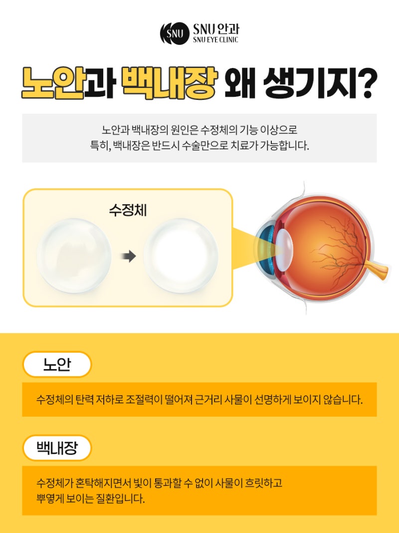 노안백내장 증상부터 수술 비용과 과정까지 SNU안과의원에서 알아보기