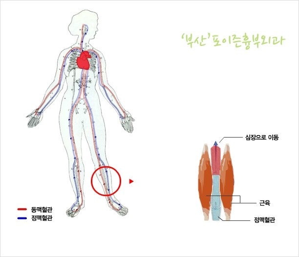 수술 후에도 걸어야 한다, 부산하지정맥류 운동