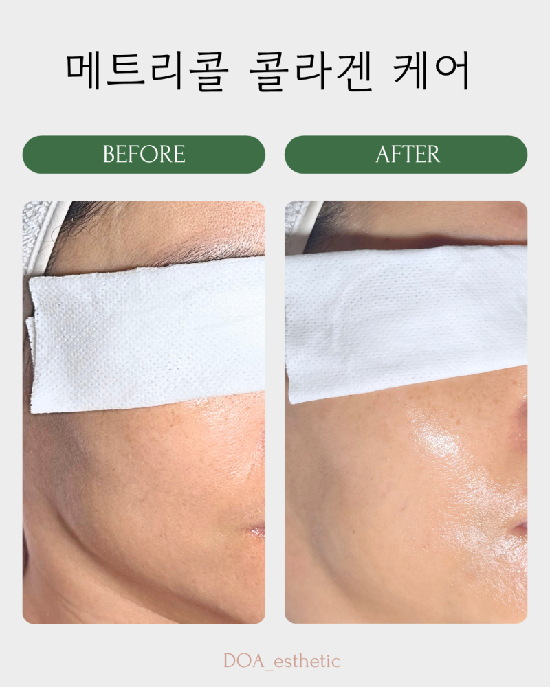 도아 에스테틱:요즘 연예인 피부관리에서 자주 들리는 메트리콜 콜라겐