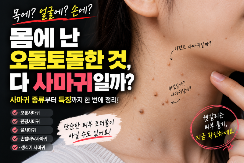 쥐젖인 줄 알았는데 사마귀? 헷갈리는 피부 돌기 총정리