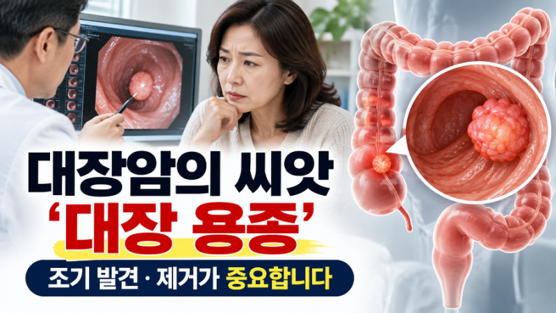 대장암의 씨앗 ‘대장 용종’｜대장내시경으로 조기 발견·제거가 중요한 이유