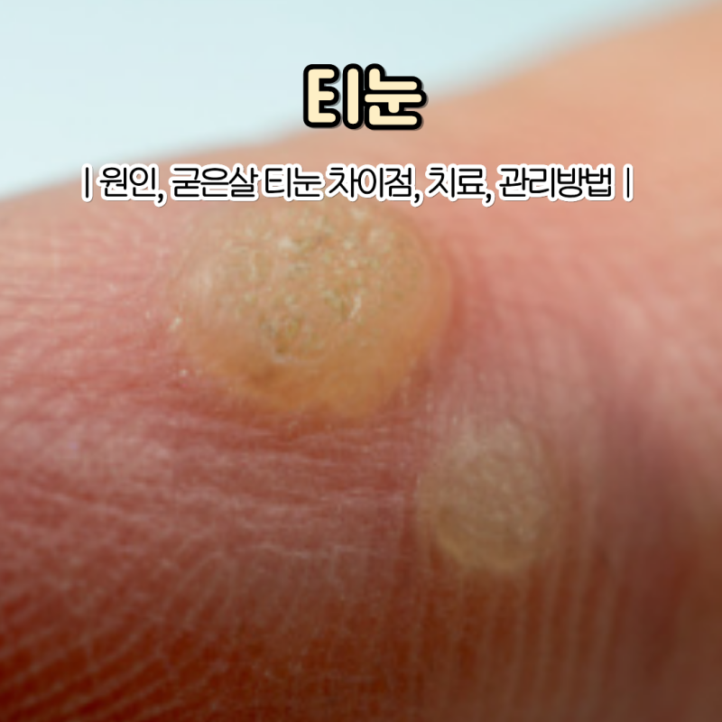 "같은 곳에 계속 생긴다면?" 티눈 생기는 이유 제거 방법 4가지