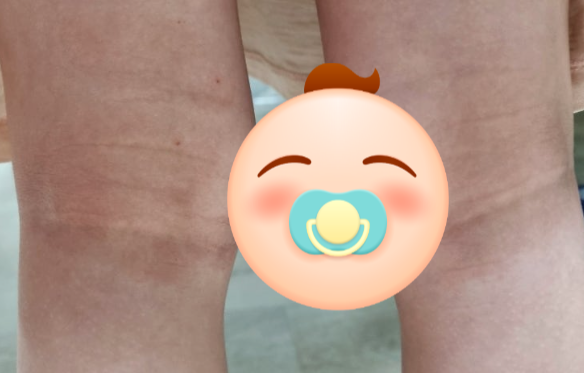 아기 스테로이드 연고에 먹는 스테로이드약까지 썼는데 오히려 더 심해졌던 이유(리도맥스0.....