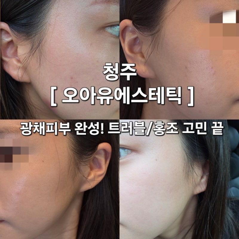 청주 웨딩관리 에스테틱 추천 [오아유에스테틱] 데콜테 맛집
