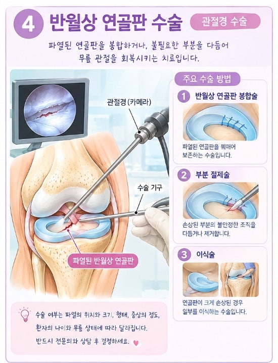 반월상 연골판 파열, 무릎이 아프고 소리가 난다면?
