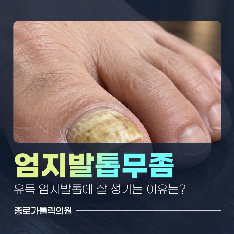 종로가톨릭의원 엄지발톱무좀 신발 때문일까 무좀 때문일까? 구별해보기