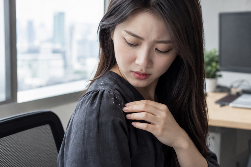 지루성두피염, 비듬이랑 뭐가 다를까