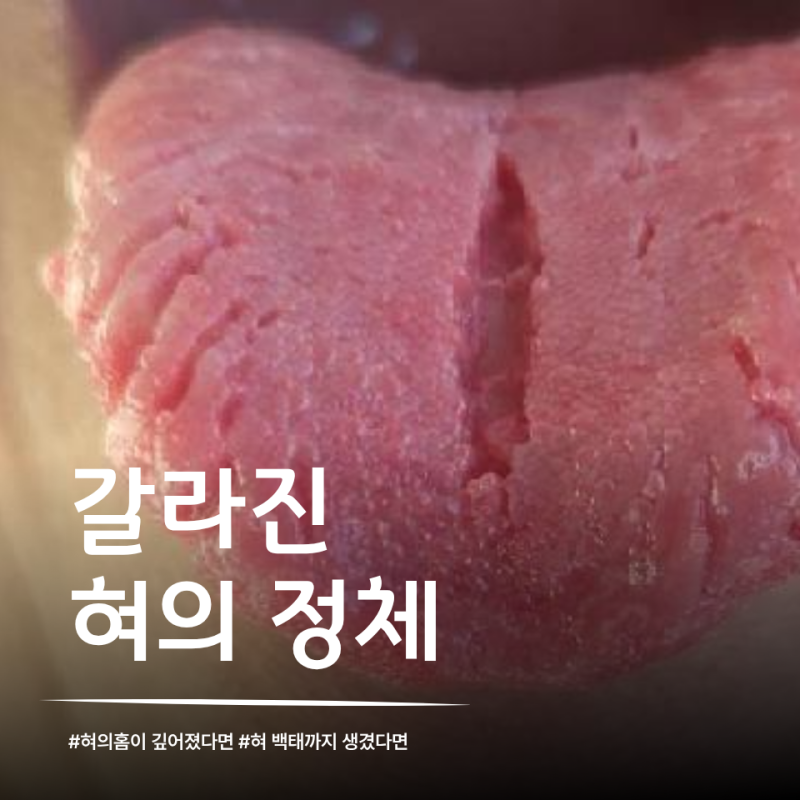 “거울 봤더니 혀가 쩍쩍 갈라져 있습니다” 몸에 영양소가 부족해서일까
