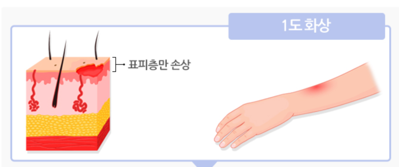 [예쀼의 건강노트] 1도 2도 3도 화상, 뭐가 다를까