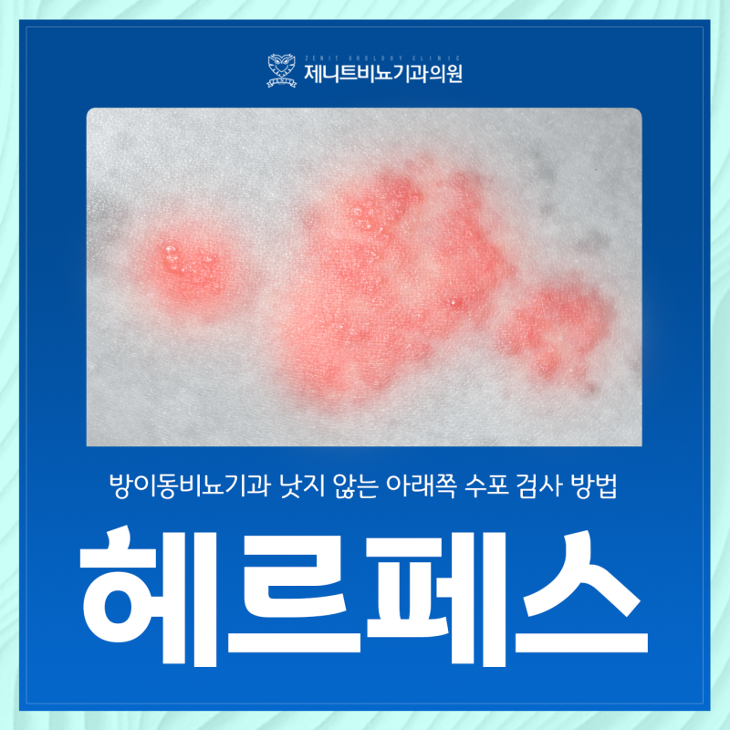 낫지 않는 아래쪽 수포, 방이동비뇨기과 헤르페스 2형 검사 방법 확인해요