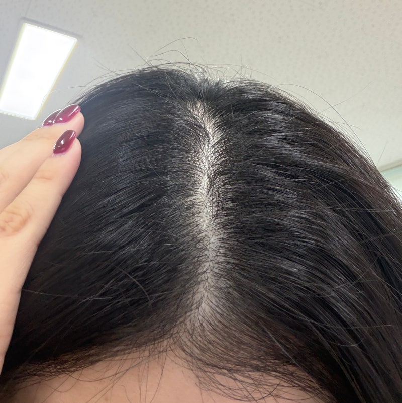 셀프 두피스케일링 추천 두피 열 내리는 방법 포셰리 두피스케일러 사용 후기