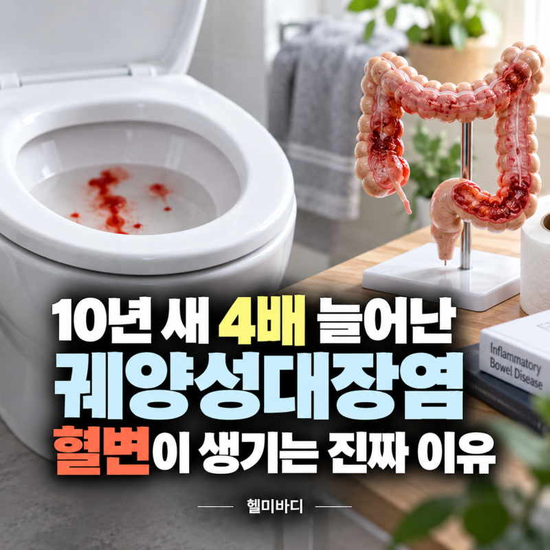10년 새 4배 늘어난 궤양성대장염 혈변이 생기는 진짜 이유
