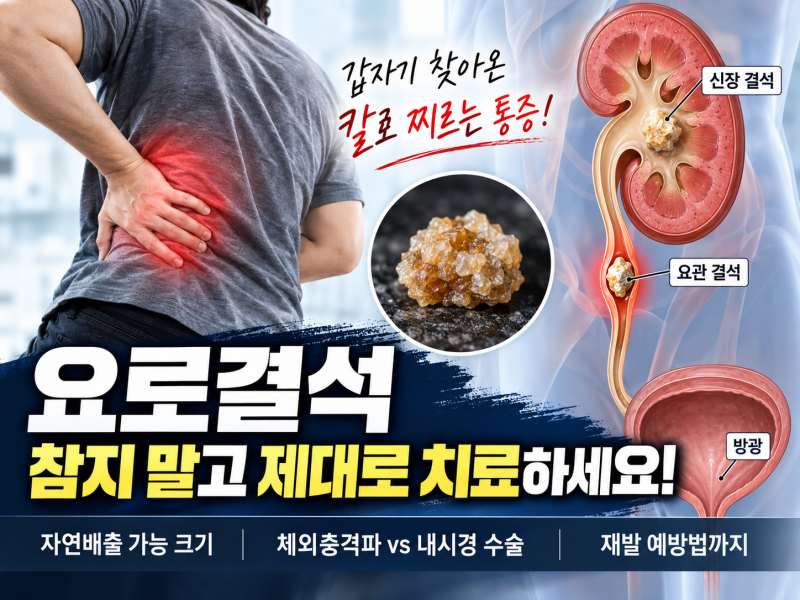 극심한 옆구리·사타구니 극통 '요로결석' 응급처치 | 결석 성분별 원인 & 체외충격파(ESWL) vs ....