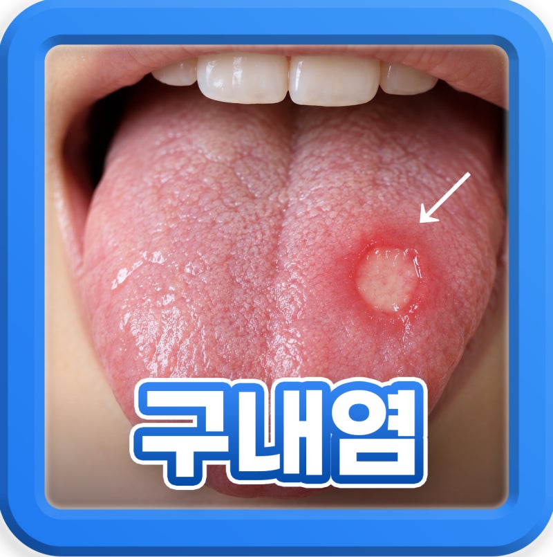 입병 혀 구내염 종류, 자꾸 생기는 원인과 빨리 낫는 관리법