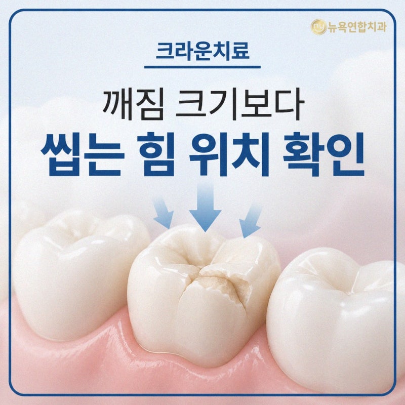 어금니 깨짐 크라운, 범위에 따라 메움과 나누어 보는 기준
