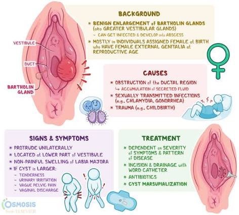 바톨린낭종 원인 뜻 증상 및 치료법