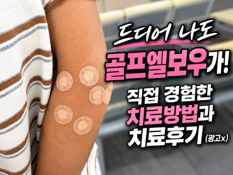 드디어 나에게도 왔다 골프엘보우가 근데 테니스엘보우까지 왔네 치료방법과 치료후기