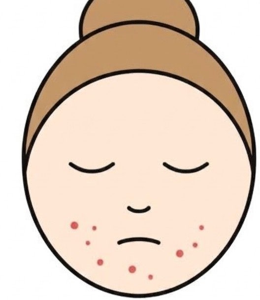 약국 아젤리아 크림은 여드름 색소침착·자국에 진짜 효과 있을까?