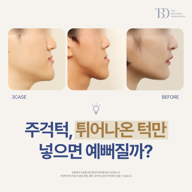 부산 주걱턱 수술, 무조건 턱을 많이 넣는다고 예뻐질까?