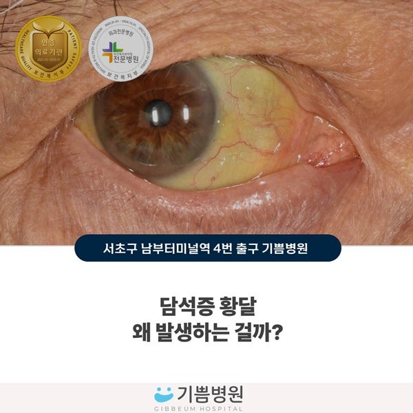 담석증과 황달은 어떤 연관이 있나요?