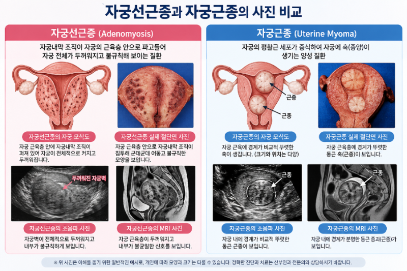 자궁선근증과 자궁근종