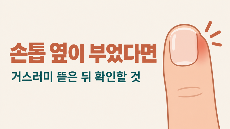조갑주위염 손톱 거스러미 뜯고 부었을 때 며칠까지 지켜볼까