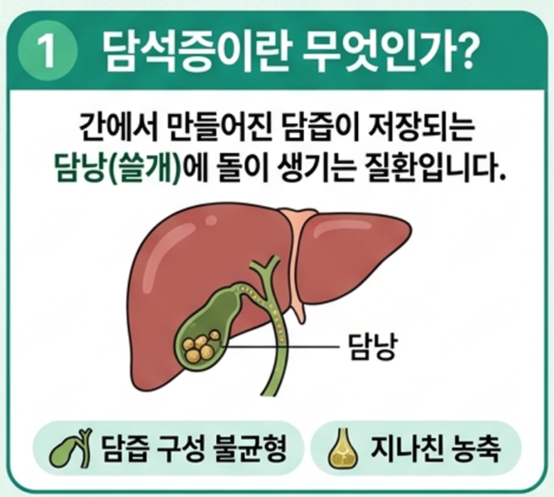 부산담석증 “체한 줄 알았는데…” 증상과 통증, 수술이 필요한 경우
